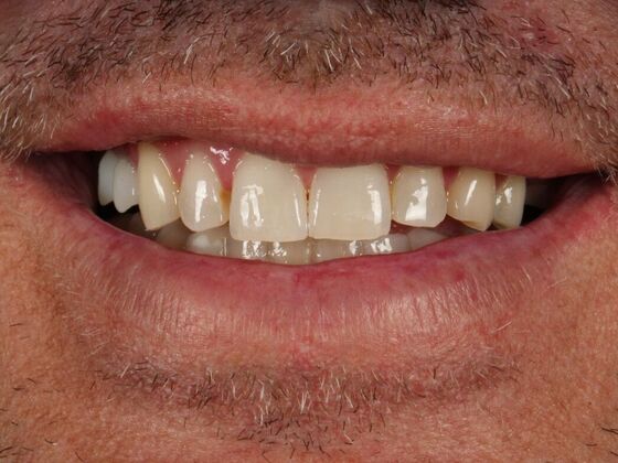 Porcelain Veneers: Walt - Before