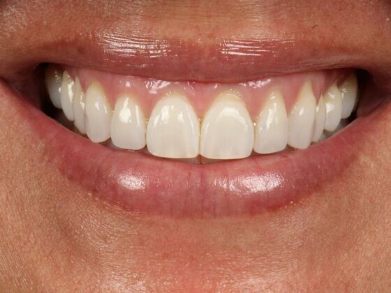 Porcelain Veneers: Kelly - Before