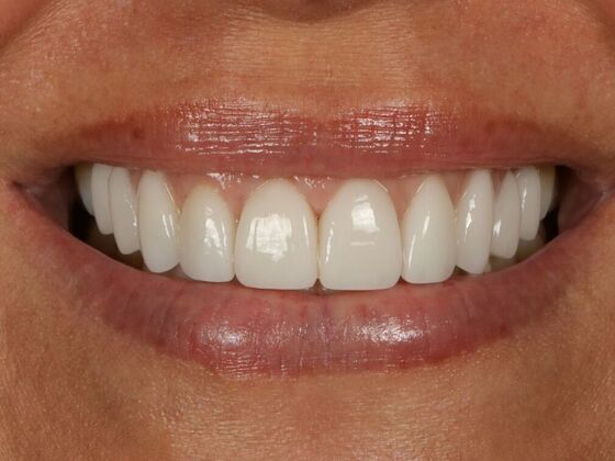 Porcelain Veneers: Kelly - After