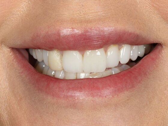 Porcelain Veneers: RoseAnne - Before