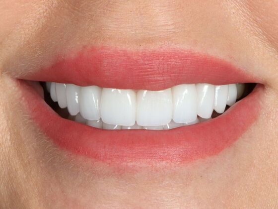 Porcelain Veneers: RoseAnne - After