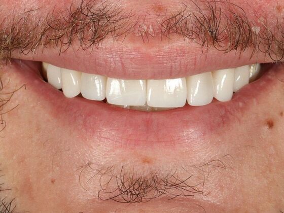 Porcelain Veneers: Derek - After