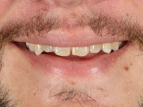 Porcelain Veneers: Derek - Before