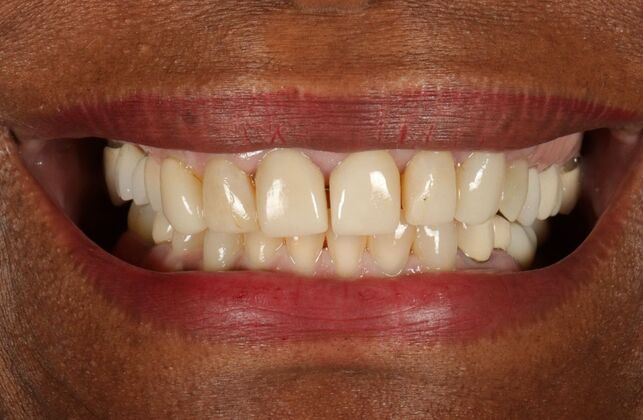 Dental Implants: Sheila - Before