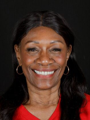 Dental Implants Sheila - Before