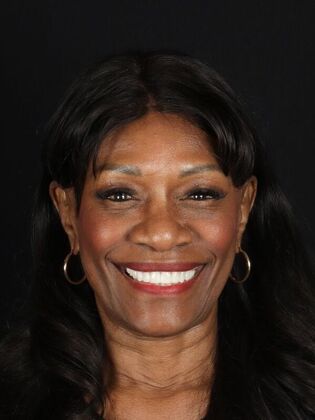 Dental Implants Sheila - After