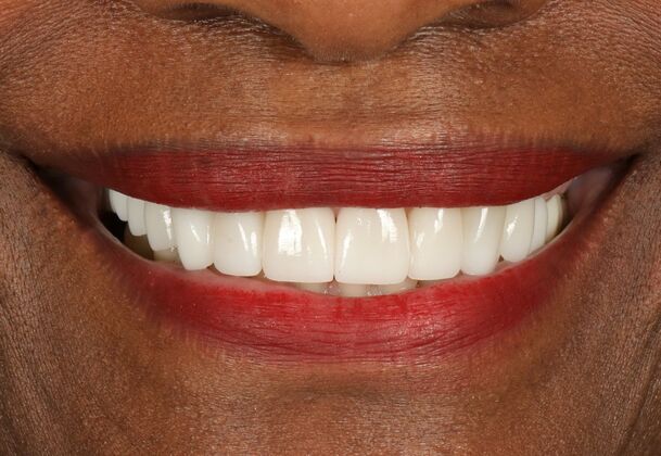 Dental Implants: Sheila - After