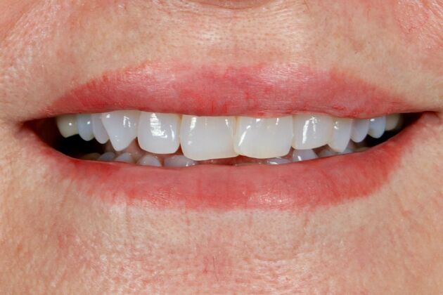 Full Mouth Rehabilitation: Judy - Before