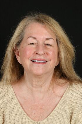 Full Mouth Rehabilitation Judy  - Before