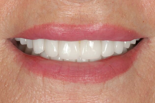Full Mouth Rehabilitation: Judy - After