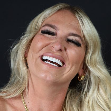 Minimal Prep Porcelain Veneers Cinzia - After