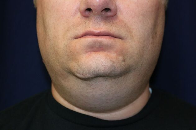 Neck Sculpting : Case 16 - Before