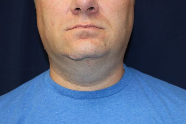 Neck Sculpting : Case 16 - After