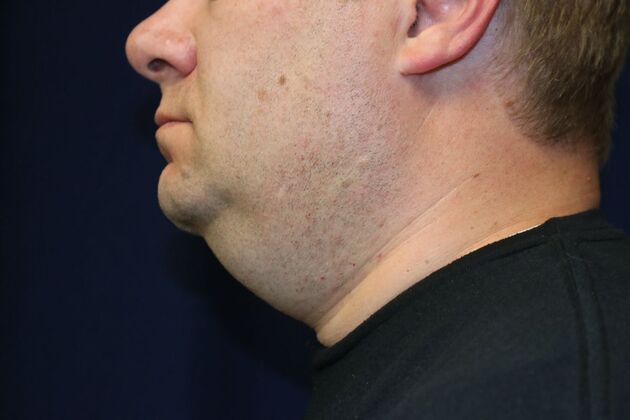 Neck Sculpting : Case 16 - Before