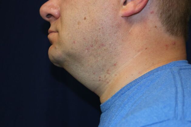 Neck Sculpting : Case 16 - After