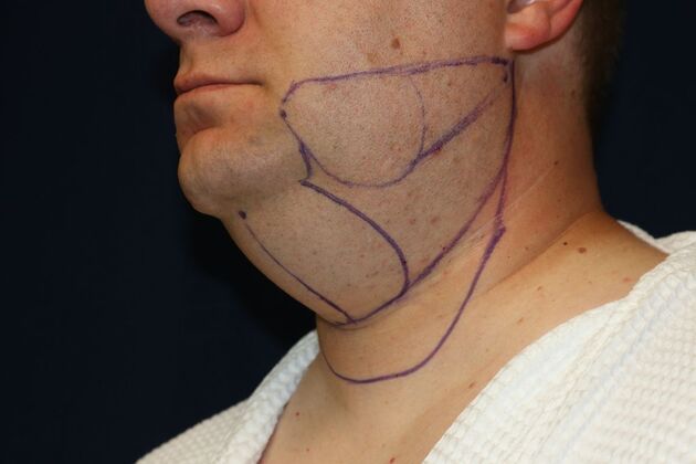 Neck Sculpting : Case 16 - Before