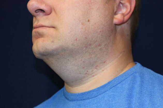 Neck Sculpting : Case 16 - After