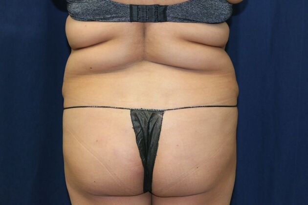 Brazilian Butt Lift : Case 20 - Before