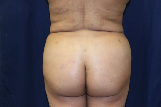 Brazilian Butt Lift : Case 20 - After