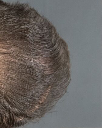 FUE Hair Restoration: Case 38 - After