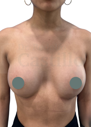 Breast Augmentation Breast Augmentation  - After