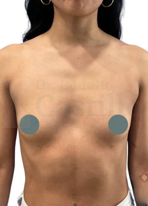 Breast Augmentation Breast Augmentation  - Before