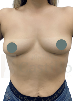 Breast Augmentation: Breast Augmentation - Before