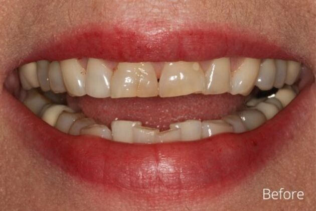 Invisalign Case 1 - Before