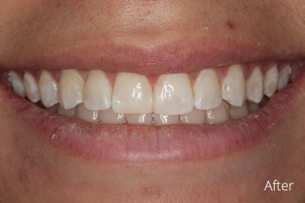 Bonding Case 1 - After