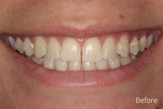 Bonding Case 1 - Before