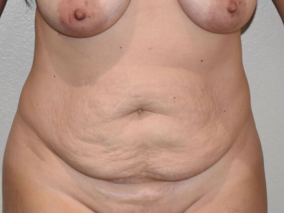 Tummy Tuck (Abdominoplasty): Case 493 - Before