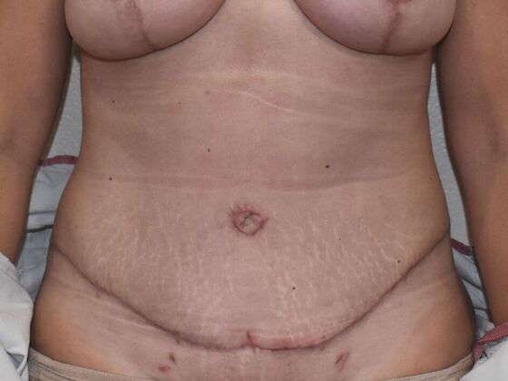 Tummy Tuck (Abdominoplasty): Case 493 - After