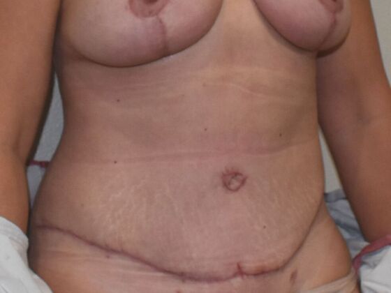 Tummy Tuck (Abdominoplasty): Case 493 - After