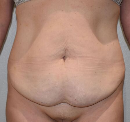Tummy Tuck (Abdominoplasty): Case 494 - Before