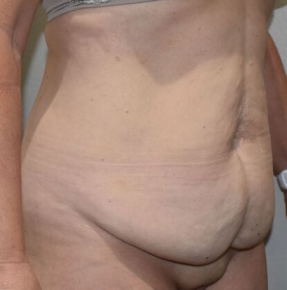 Tummy Tuck (Abdominoplasty): Case 494 - Before