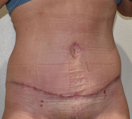 Tummy Tuck (Abdominoplasty): Case 494 - After