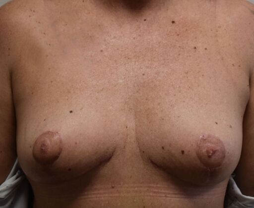 Breast Lift (Mastopexy) Case 215 - After