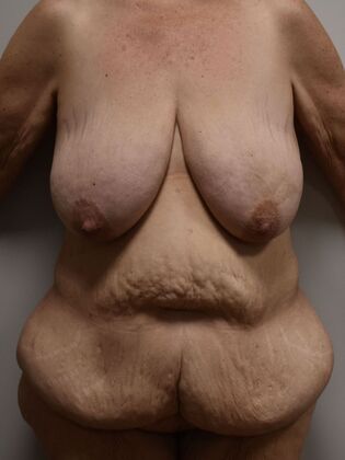 Massive Weight Loss : Case 155 - Before