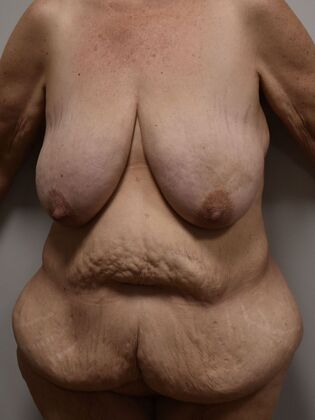 Massive Weight Loss : Case 155 - Before