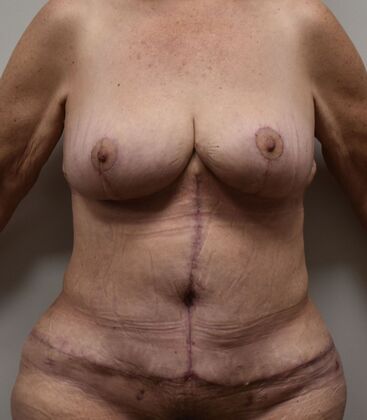 Massive Weight Loss : Case 155 - After