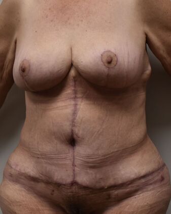 Massive Weight Loss : Case 155 - After