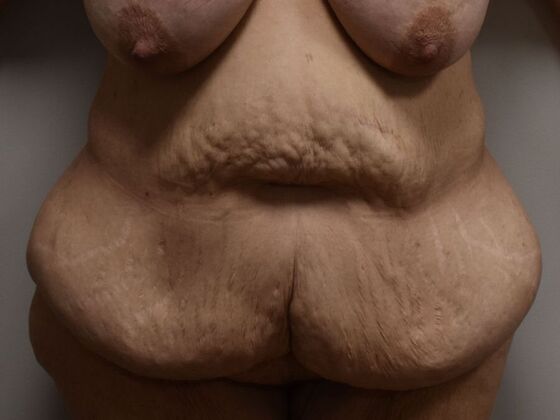 Tummy Tuck (Abdominoplasty): Case 495 - Before