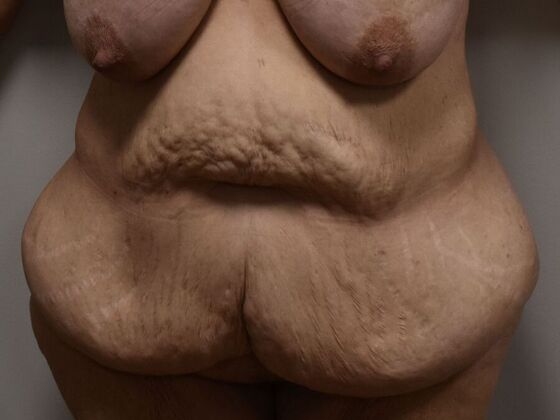 Tummy Tuck (Abdominoplasty): Case 495 - Before