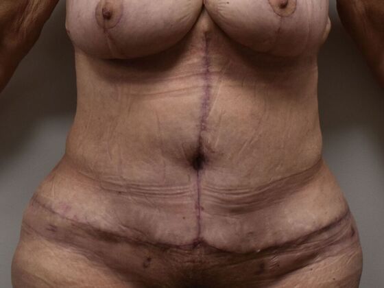 Tummy Tuck (Abdominoplasty): Case 495 - After