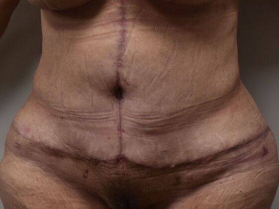 Tummy Tuck (Abdominoplasty): Case 495 - After