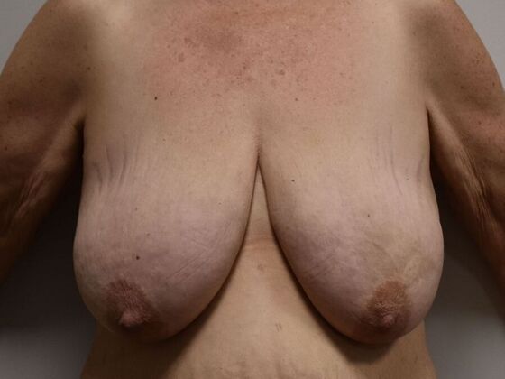 Breast Reduction: Case 186 - Before