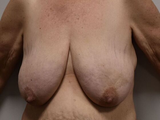 Breast Reduction: Case 186 - Before
