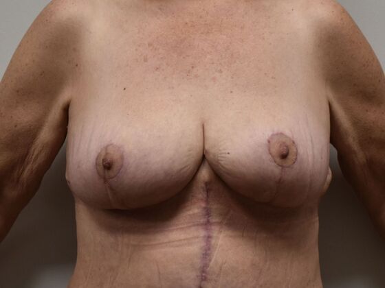 Breast Reduction: Case 186 - After