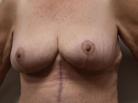 Breast Reduction: Case 186 - After