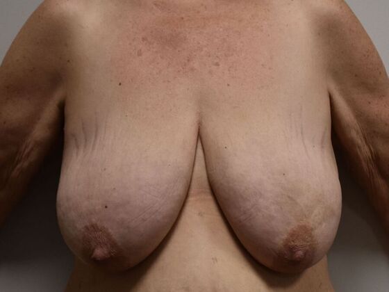 Breast Lift (Mastopexy) Case 216 - Before